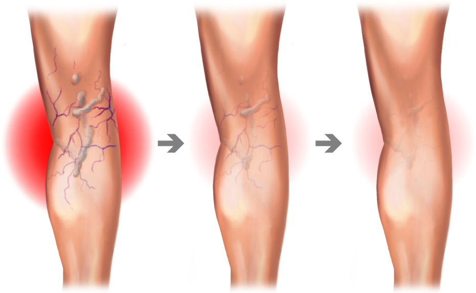 Spider And Varicose Vein Treatment Center - Varicose Vein Graphic (1080x574), Png Download
