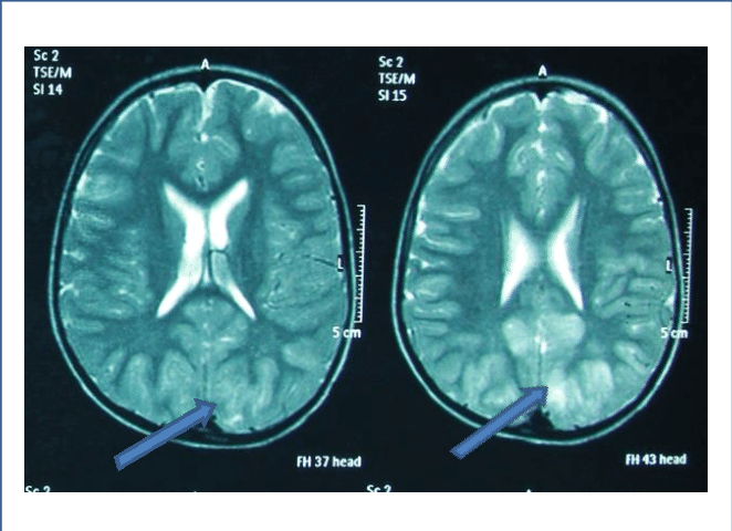 Pointers Indicating Hyper Intensity Areas In White - Computed Tomography (662x480), Png Download