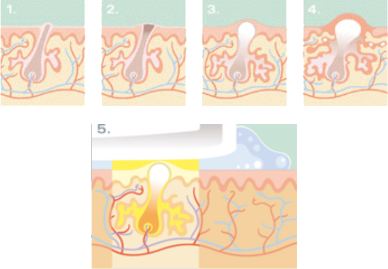 Acne And Rosacea - C1 Advanced (800x556), Png Download