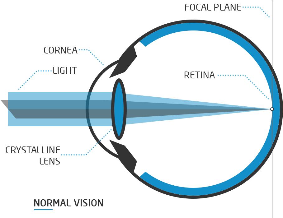 Astigmatism Surgery - Ojo Con Miopia Png (1050x750), Png Download