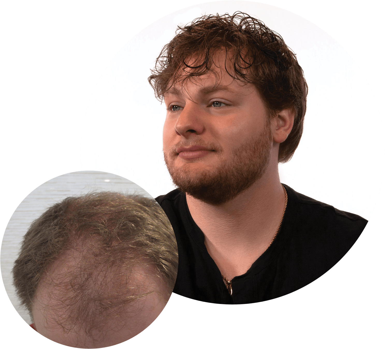 Download Nonsurgical Hair Replacement For Men PNG Image with No Background