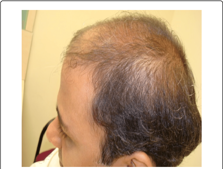 Improved Hair Growth Within 4 Months After Changing - Girl (769x579), Png Download