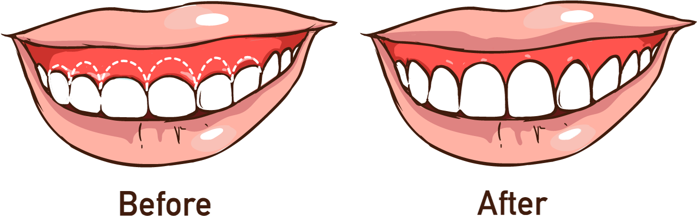Transforming Your Entire Smile - Gingivectomy (1366x436), Png Download