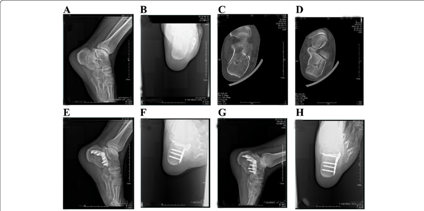 A 45 Year Old Male Patient Was Admitted To Our Hospital - Minimally Invasive Calcaneal Fracture (850x424), Png Download