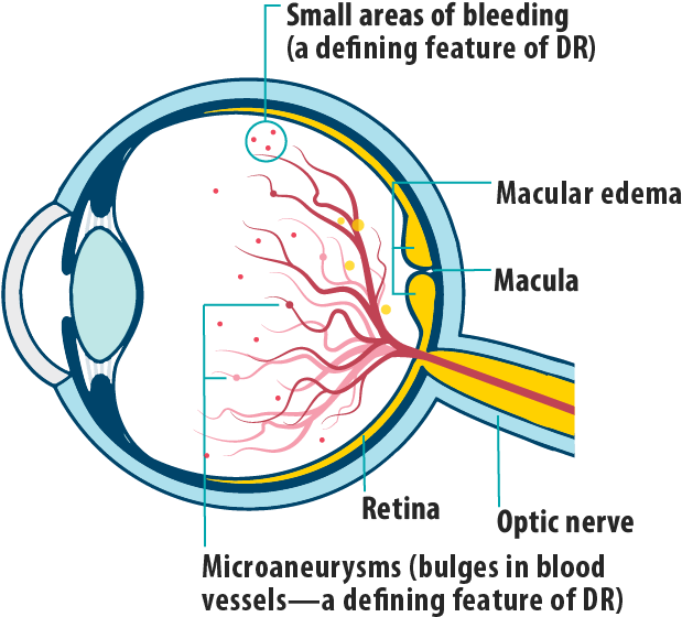 Picture Of Effects Of Dme/dr In Dme On The Eye, Showing - Diagram (782x705), Png Download