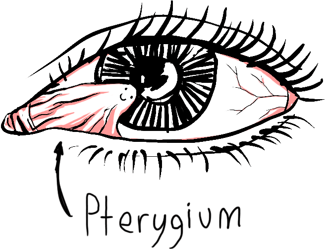 A Pterygium Is A Pinkish To Dark Red Triangular Wing (665x508), Png Download