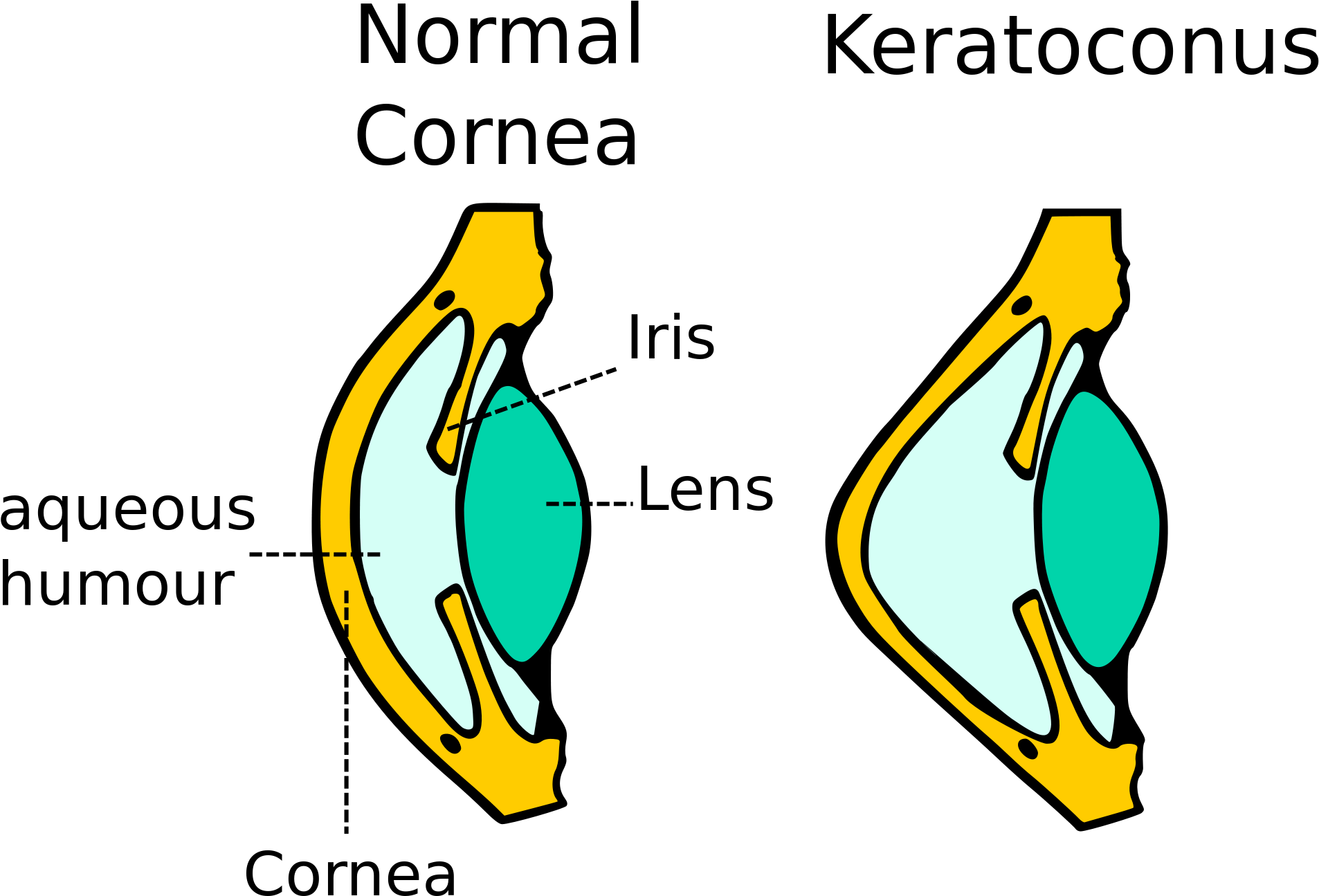 Kerataconus Image - Does Keratoconus Work (2000x1464), Png Download