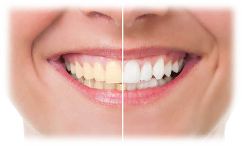 Tooth Whitening - 歯 が 黄色い リップ (821x495), Png Download
