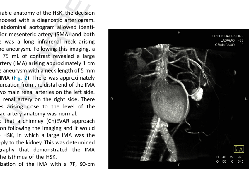 Horseshoe Kidney Classification System Based On The (850x578), Png Download