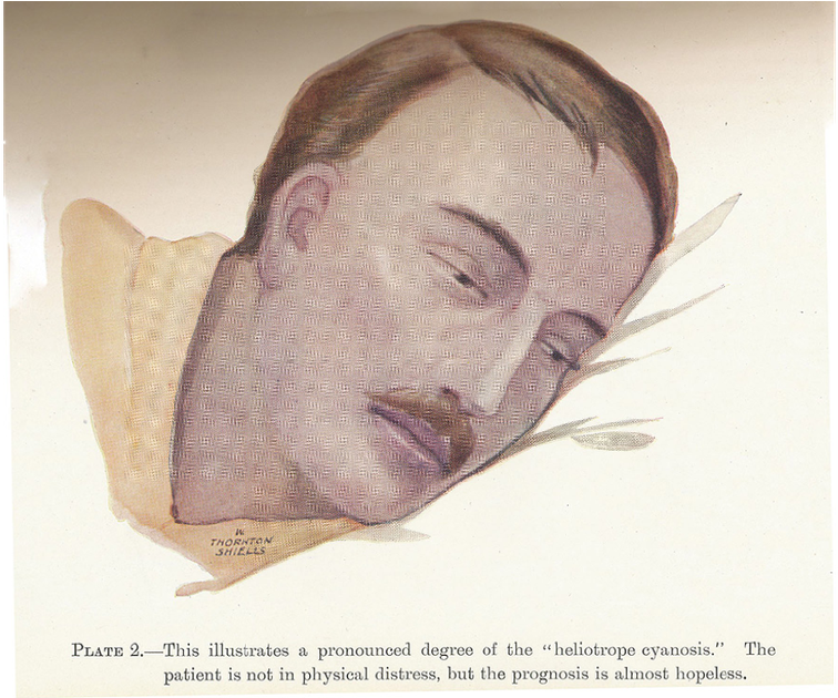 This Drawing Of A Man With Cyanosis Shows The Purple-blue - Visual Arts (1338x629), Png Download