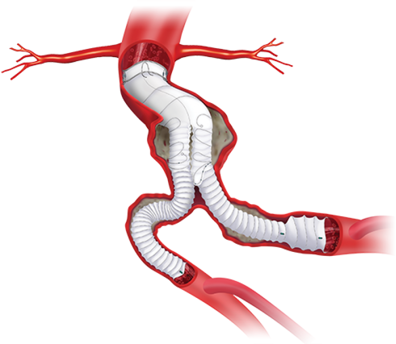 Product Availability Subject To Local Regulatory Approval - Anaconda Graft (800x686), Png Download