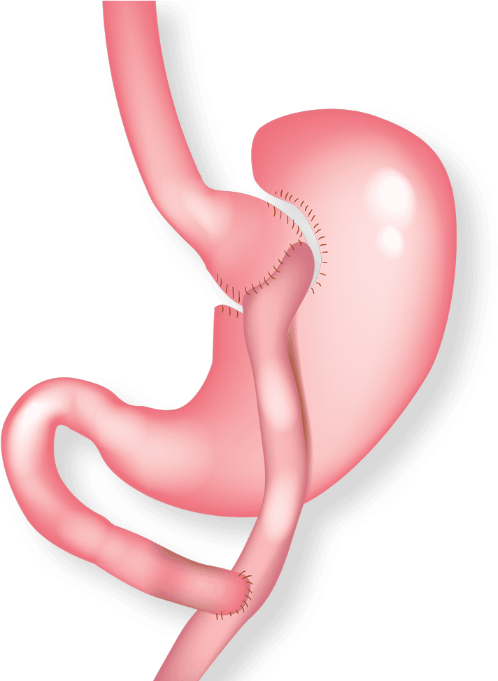 Illustration Of Gastric Bypass - Balloon (773x972), Png Download