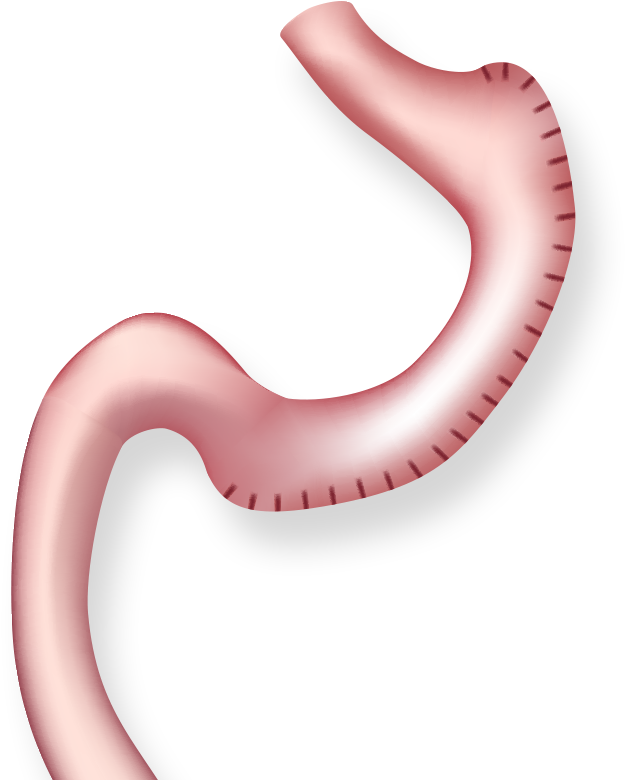Illustration Of Stomach After Gastric Plication - Tüp Mide Ameliyatı (808x972), Png Download