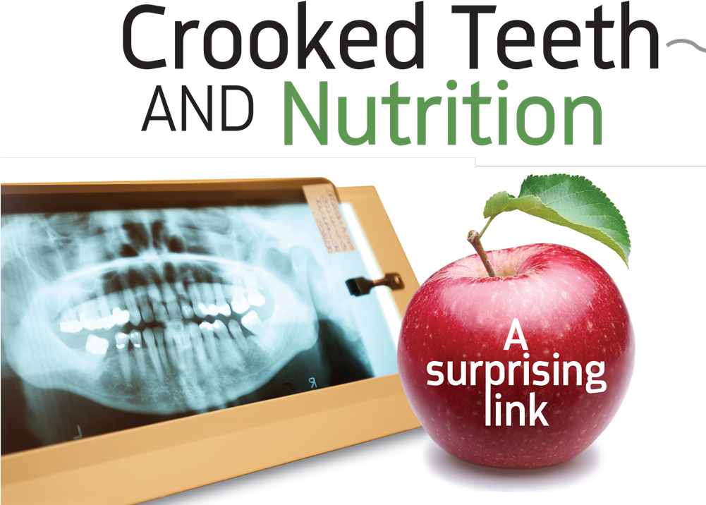 Crooked Teeth And Nutrition By Dr - Apple (1000x741), Png Download