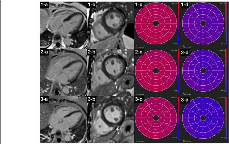 Lge Images, Native T1 And Ecv Bull's Eye Plots Of A - Circle (850x460), Png Download