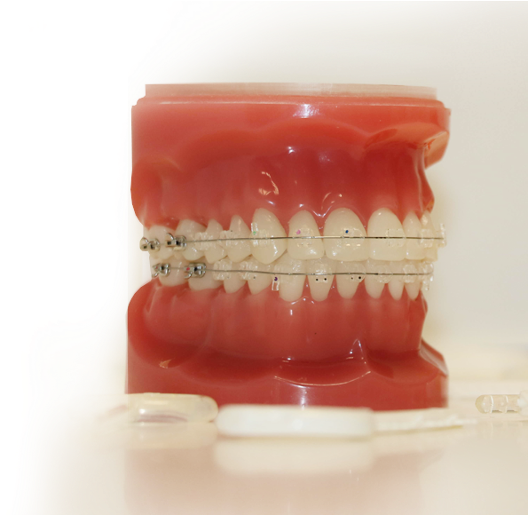 Clear Braces - Plastic (655x579), Png Download