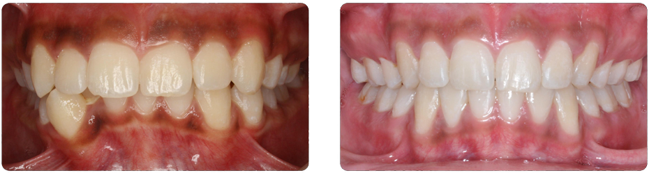 Deep Bite And Severe Lower Crowding That Were Corrected - Vampire (1000x323), Png Download
