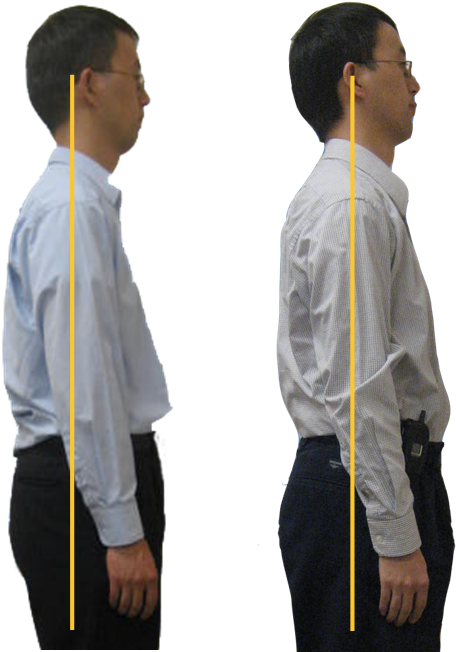 Breathing Difficulties - Forward Neck Posture Before And After (549x675), Png Download