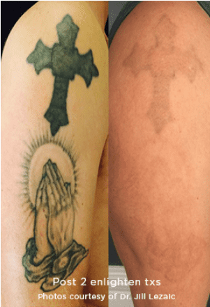 Tattoo Removal* - Tattoo (1060x440), Png Download