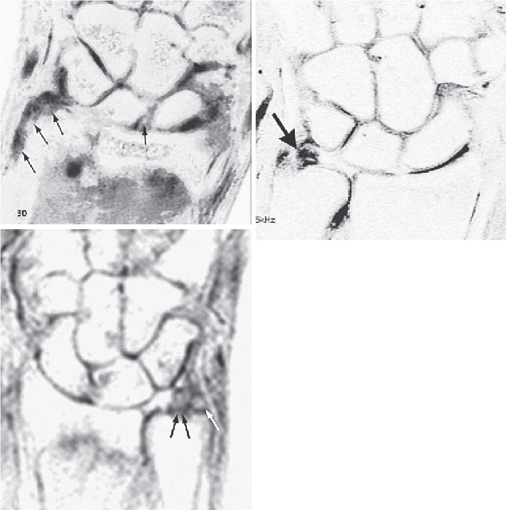 Triangular Fibrocartilage Tear Syndrome - Medical Imaging (1032x1067), Png Download