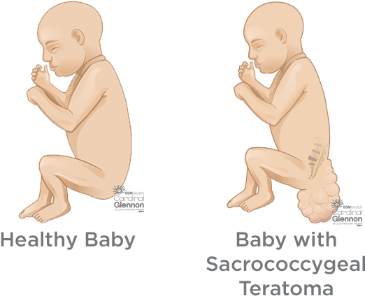 How Is Sct Diagnosed During Pregnancy - Children’s Healthcare Of Atlanta (620x520), Png Download