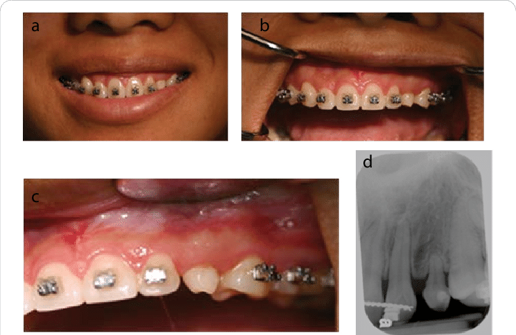 Situation After Completion Of Orthodontic Treatment - Collage (744x484), Png Download