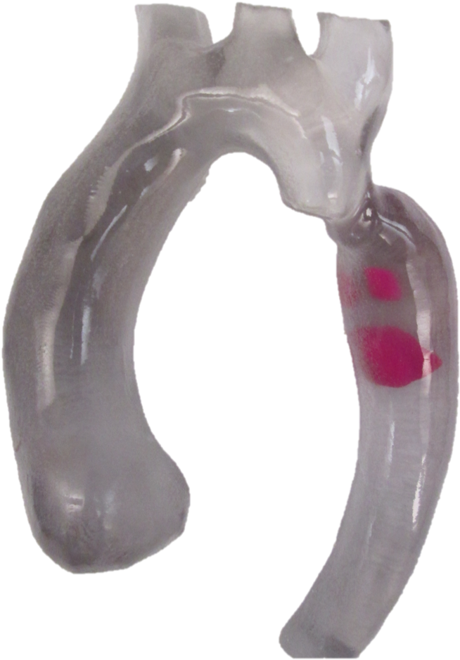 3d Printed Aortic Arch With Thrombus - Diagonal Pliers (779x1056), Png Download