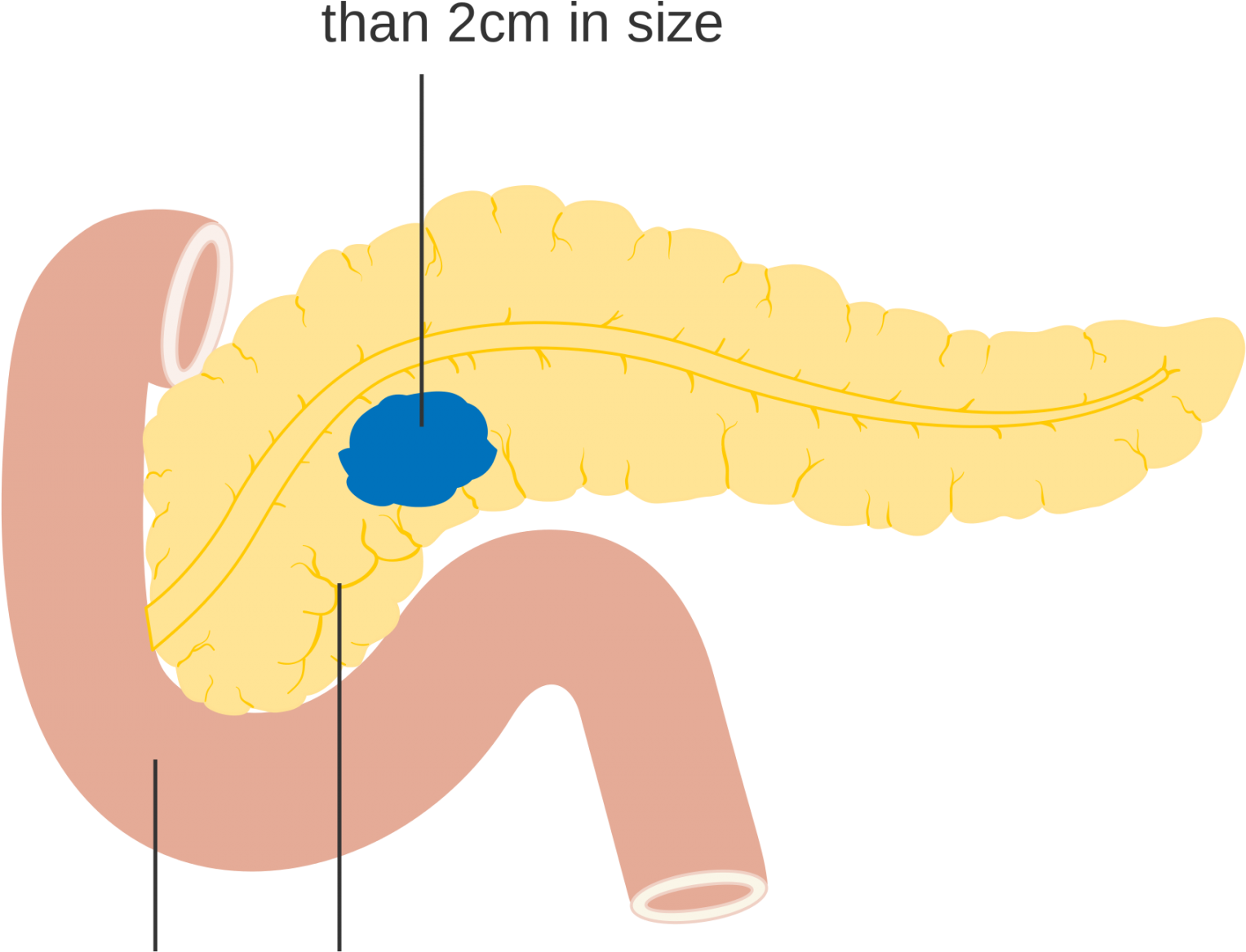 P Pancreatic Cancer - Diagram (1800x1200), Png Download