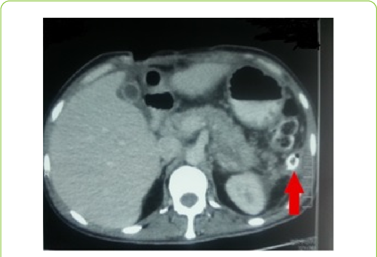Post Operative Pancreatic Contrast Enhanced Ct Abdomen - Radiology (769x524), Png Download
