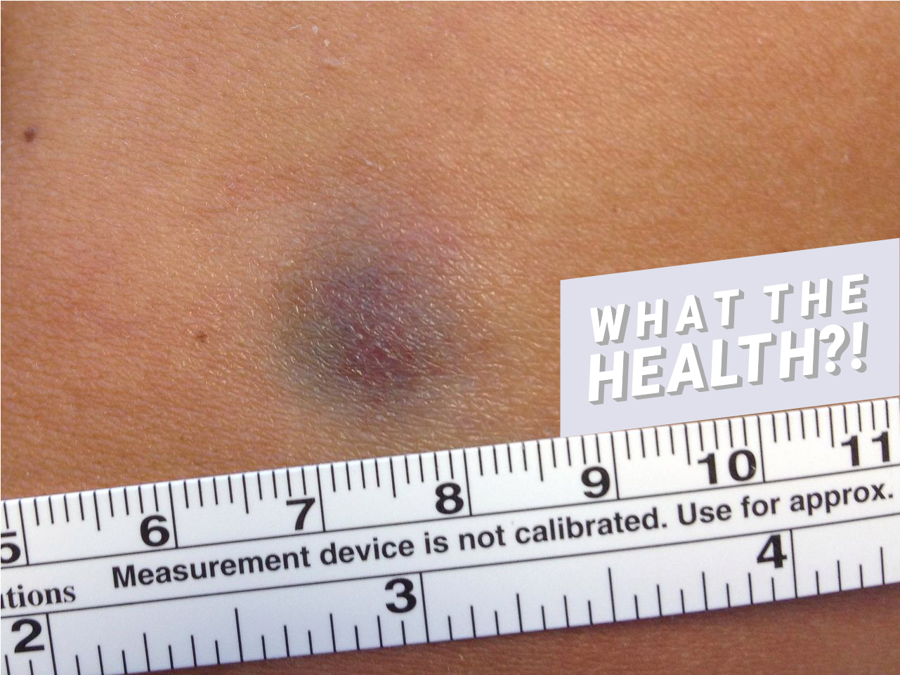 Bruise Skin Woman Health Condition Disease - Scar (1706x960), Png Download