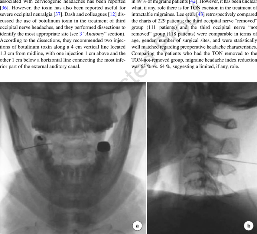 21 Open-mouth Radiofrequency Lesioning - Radiology (850x774), Png Download