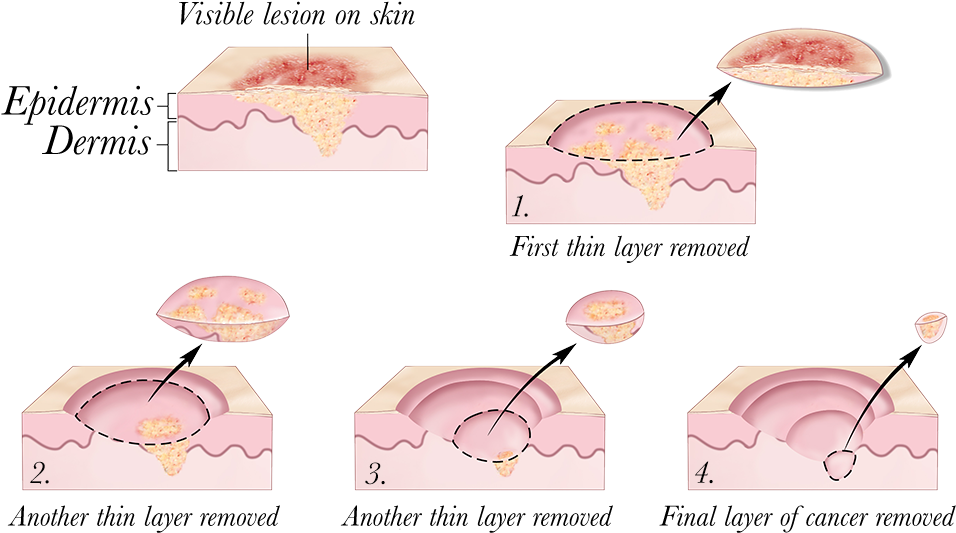 2010 Terese Winslow - Mohs Surgery (1000x551), Png Download