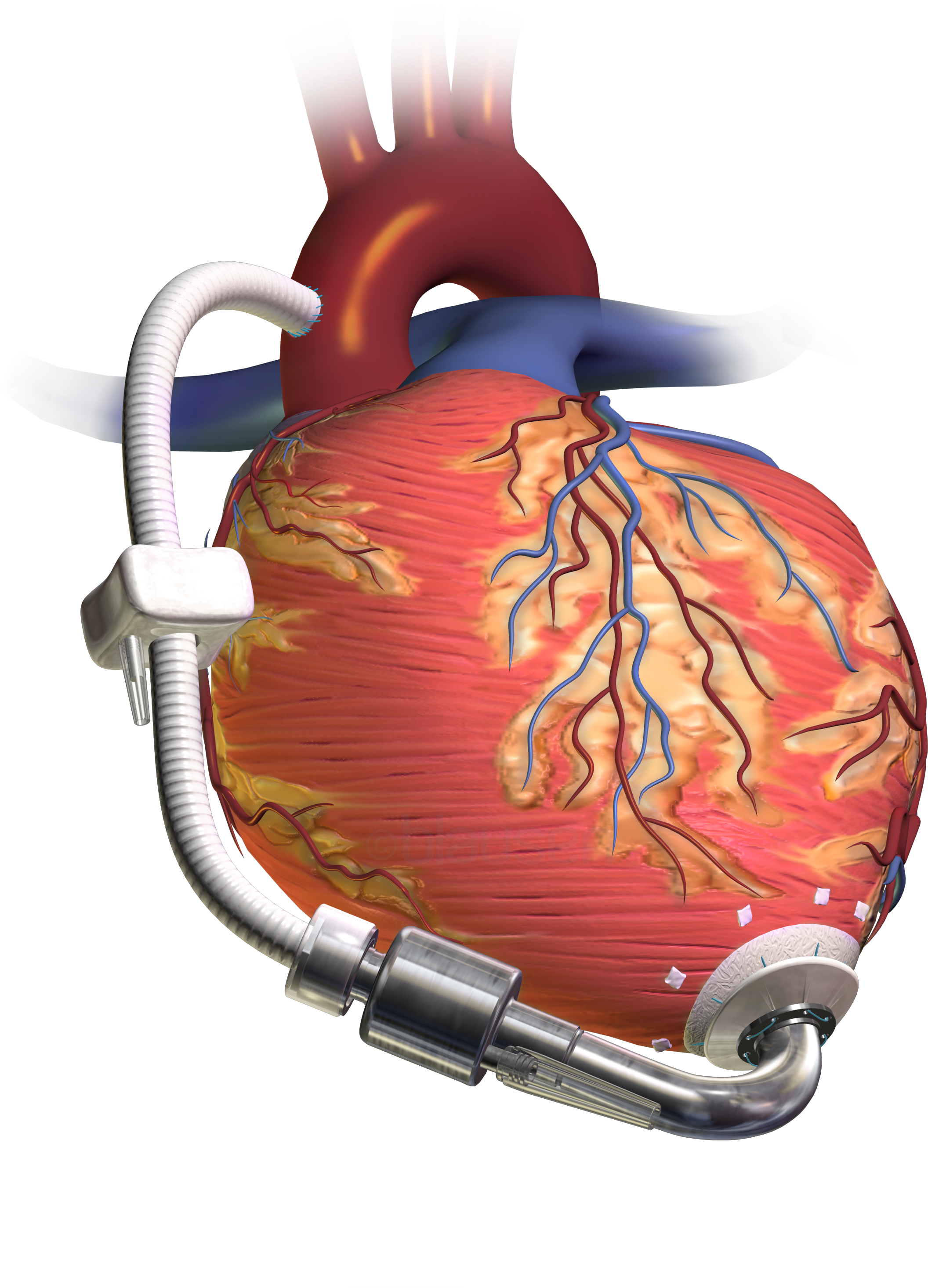 Henrico To Provide Ems Training For Patients With Heart - Heart Lvad (2400x3000), Png Download