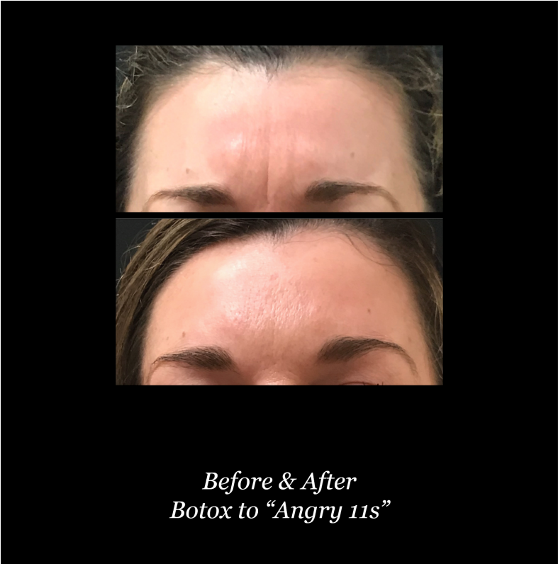 Both Botox® And Dysport Are Reversible If The Patient - Poster (1024x795), Png Download