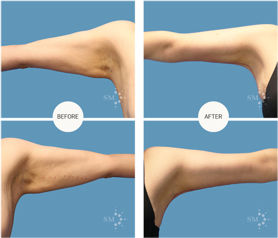 Brachioplasty - Jumping (600x600), Png Download