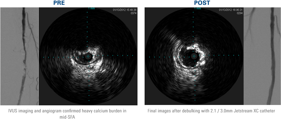 Noticeable Calcium Reduction In Right Sfa After Treatment - Calcium On Ivus (925x438), Png Download