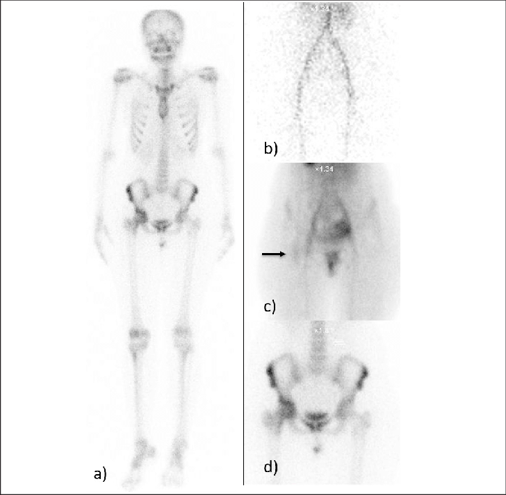 A)-(d) Bone Scan Showing Increased Blood Pool (arrow) - Uptake (728x712), Png Download