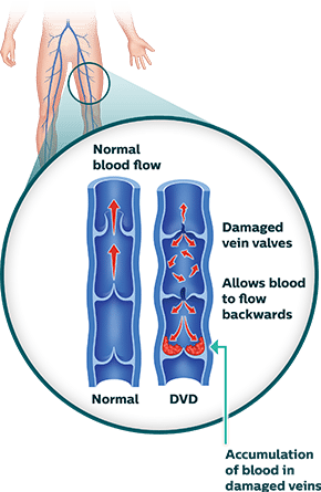 Deep Venous Disease - Dvo Deep Venous Obstruction (290x445), Png Download