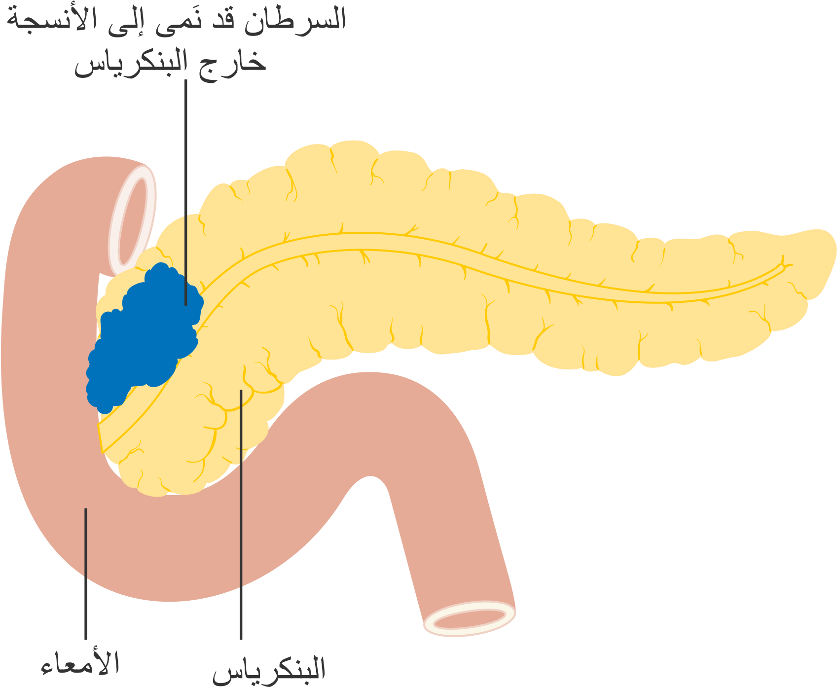 Open - Cancer De Pancreas Png (2000x1707), Png Download