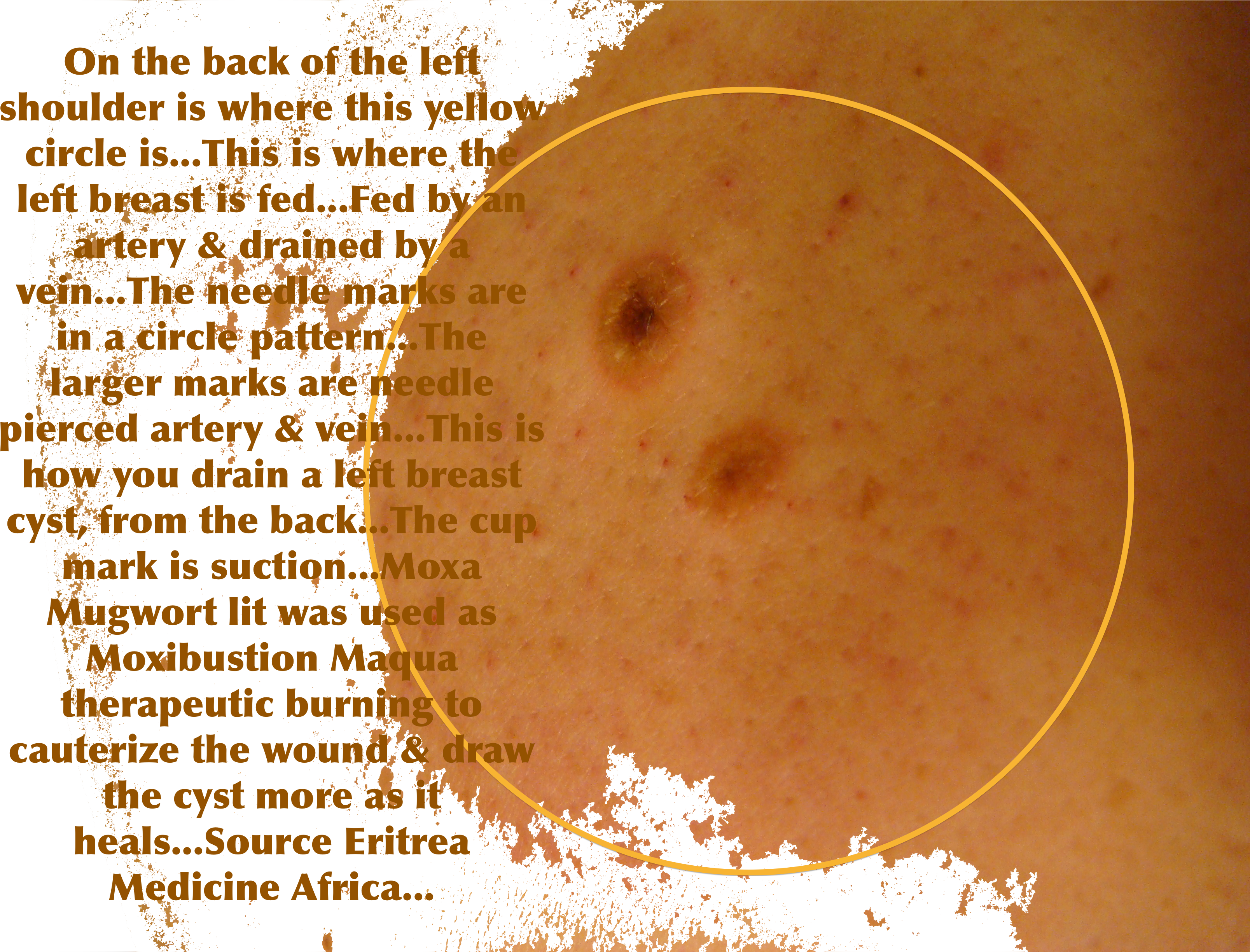 Cupping - Fire Cupping Cyst (3264x2448), Png Download