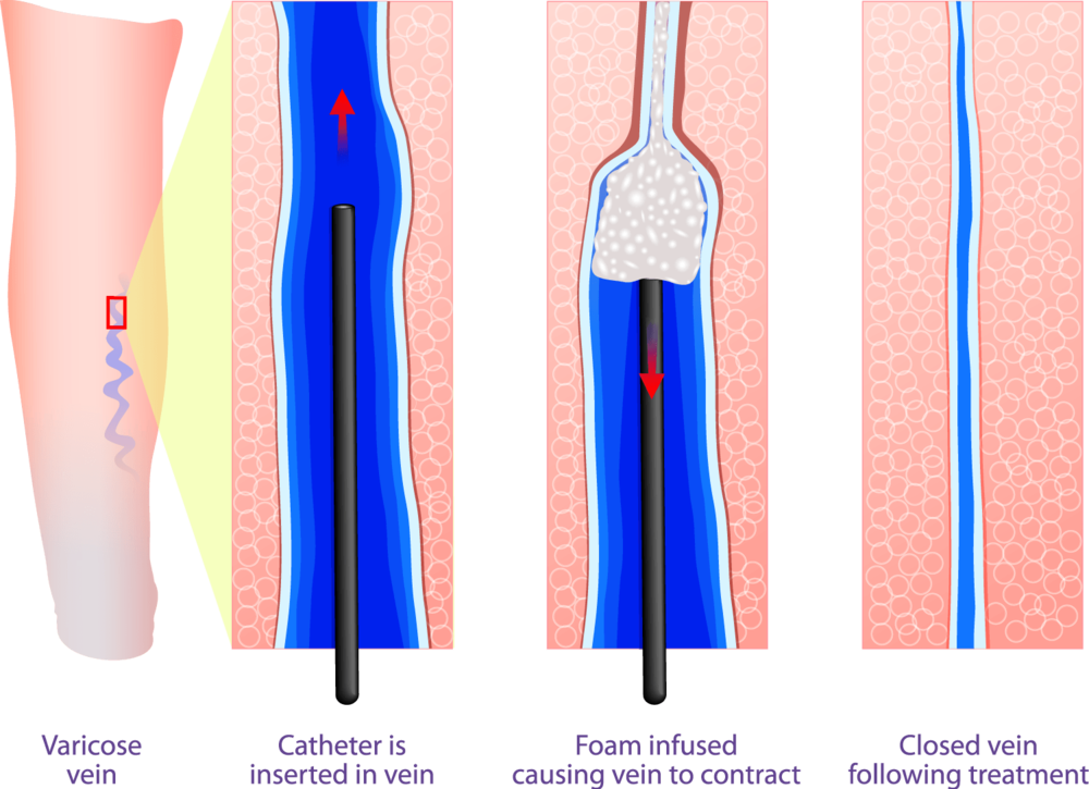 Sclerotherapy-treatment (1000x725), Png Download
