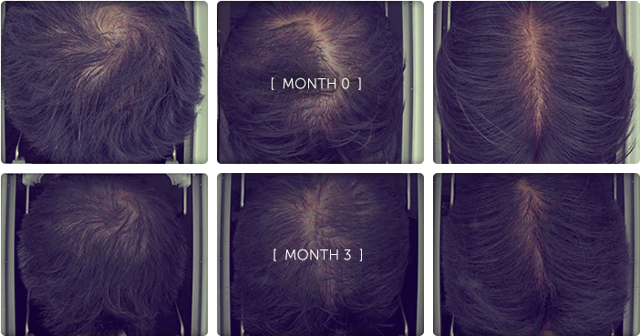 Plga Before After - Lace Wig (779x455), Png Download