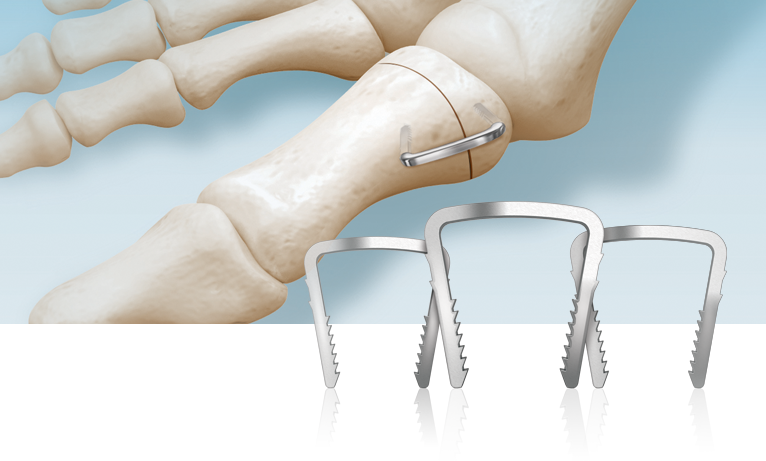 Neospan Se Compression Staple - Basic Pump (766x461), Png Download