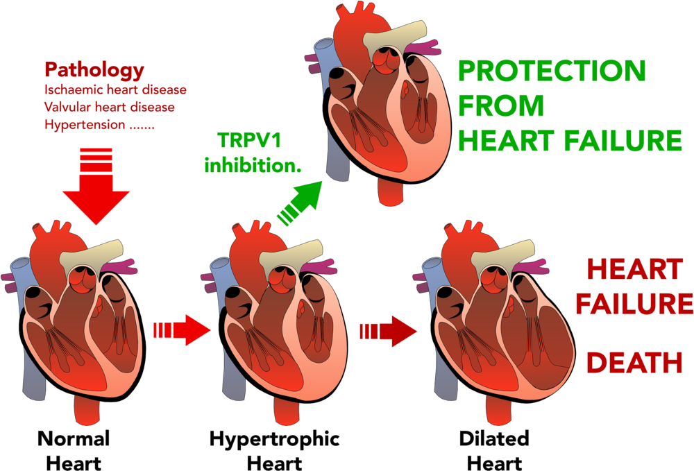Download Png Transparent Stock Disease Clipart Heart Damage Hypertrophy Heart Failure Png Image With No Background Pngkey Com