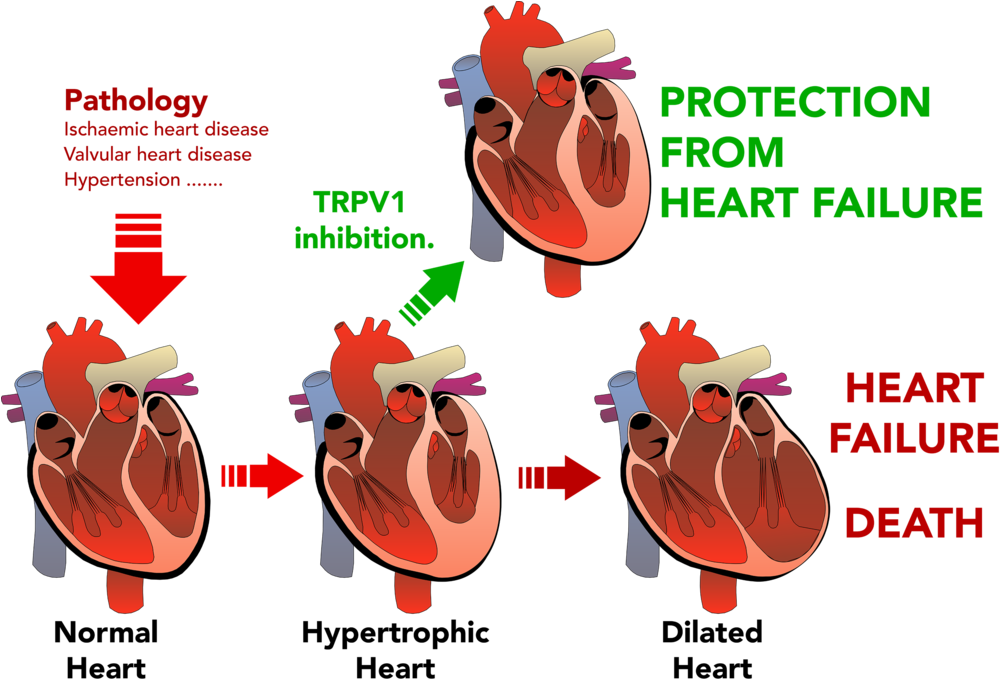 Png Transparent Stock Disease Clipart Heart Damage - Hypertrophy Heart Failure (1000x691), Png Download