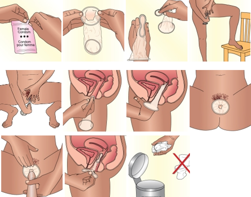 Before Using The Female Condom For The First Time During - Use Condom (830x650), Png Download