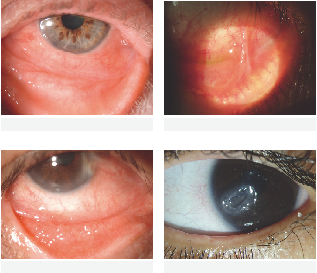 Ocular Surface Disease - Close-up (1094x942), Png Download