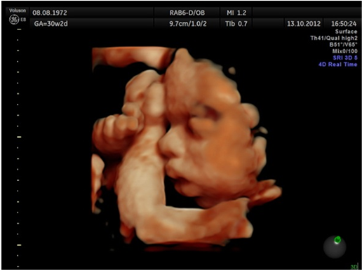 Immobile Fetus At 31 Weeks - Ultrasound 4d 31 Week (902x384), Png Download