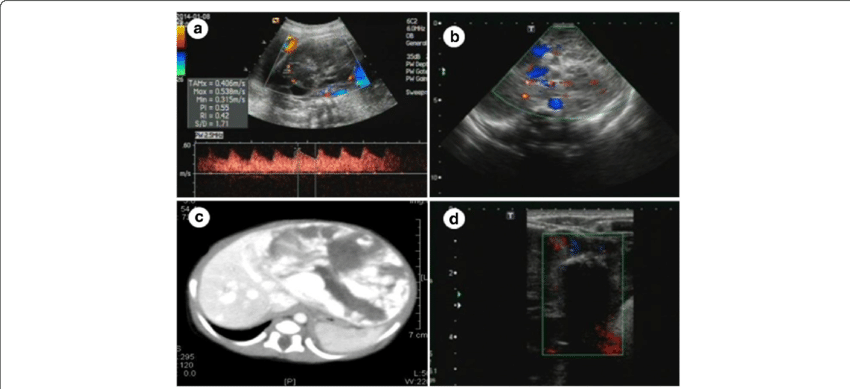 Fetus With Multiple Hemangiomas In The Whole Liver - Computed Tomography (850x389), Png Download
