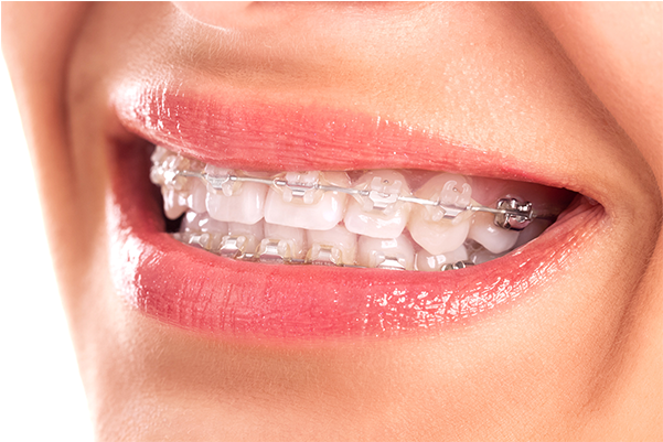 Brackets-esteticos - White Braces (600x600), Png Download